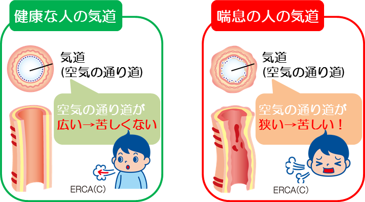 喘息は子供から大人まで切れ目のない治療が必要です